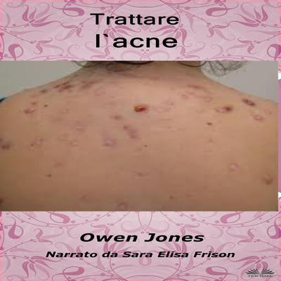 Trattare l`acne by Owen Jones audiobook